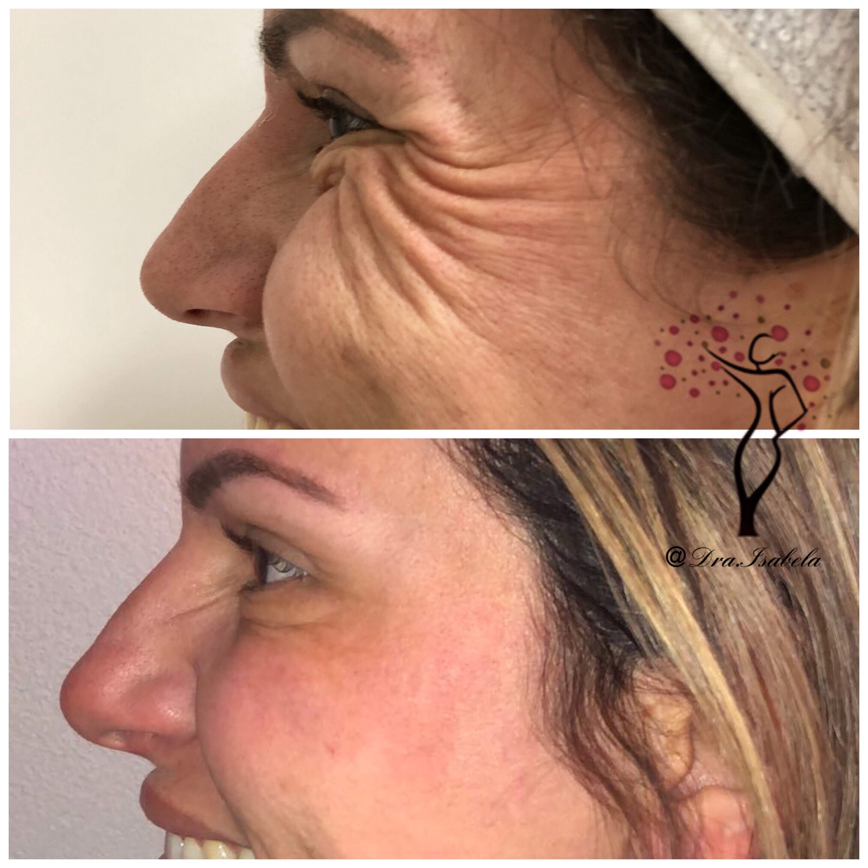 Toxína Botulínica (Botox)