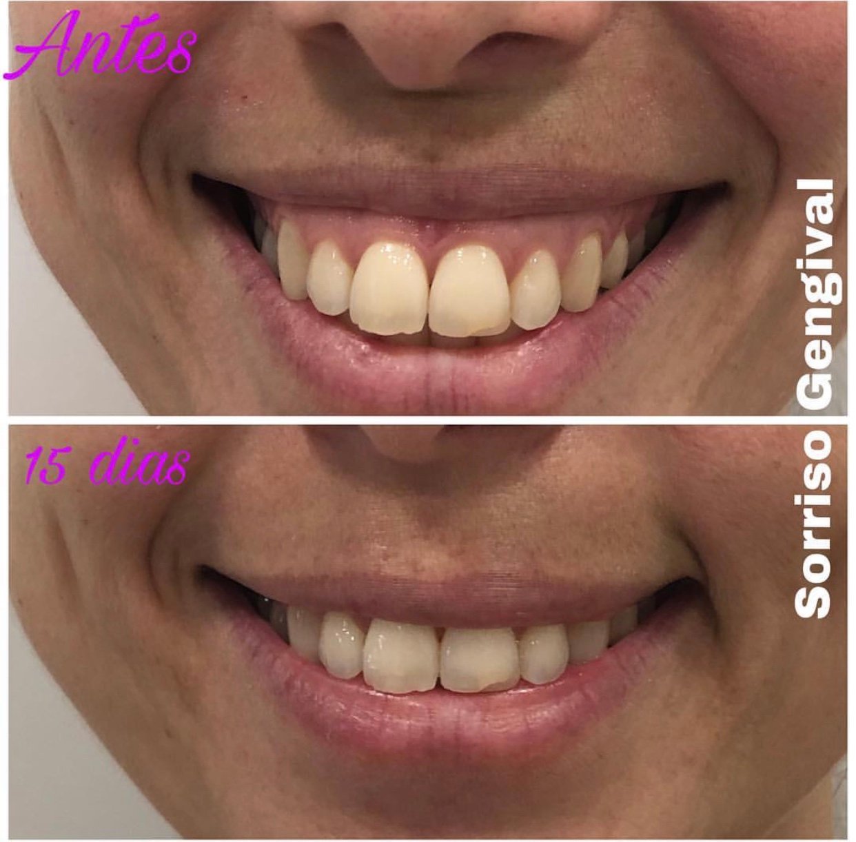 Tratamento sorriso gengival
