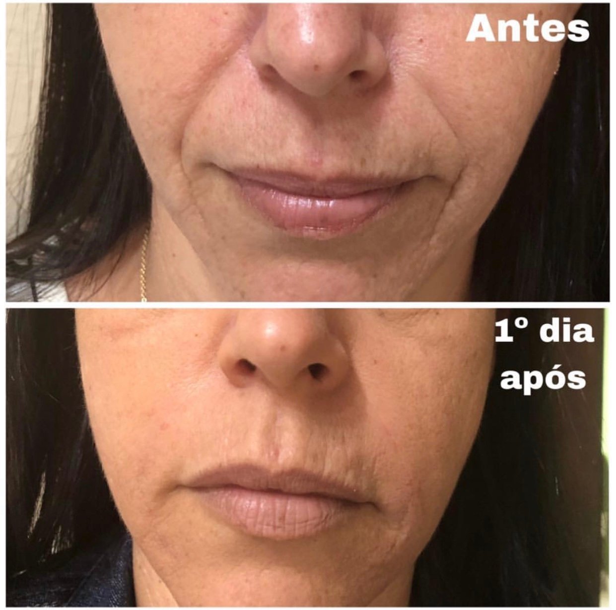 Preenchimento Bigode Chinês / nasogeniano