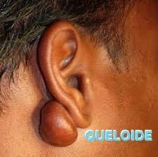 Tratamento de Queloide em Lóbulo de Orelha