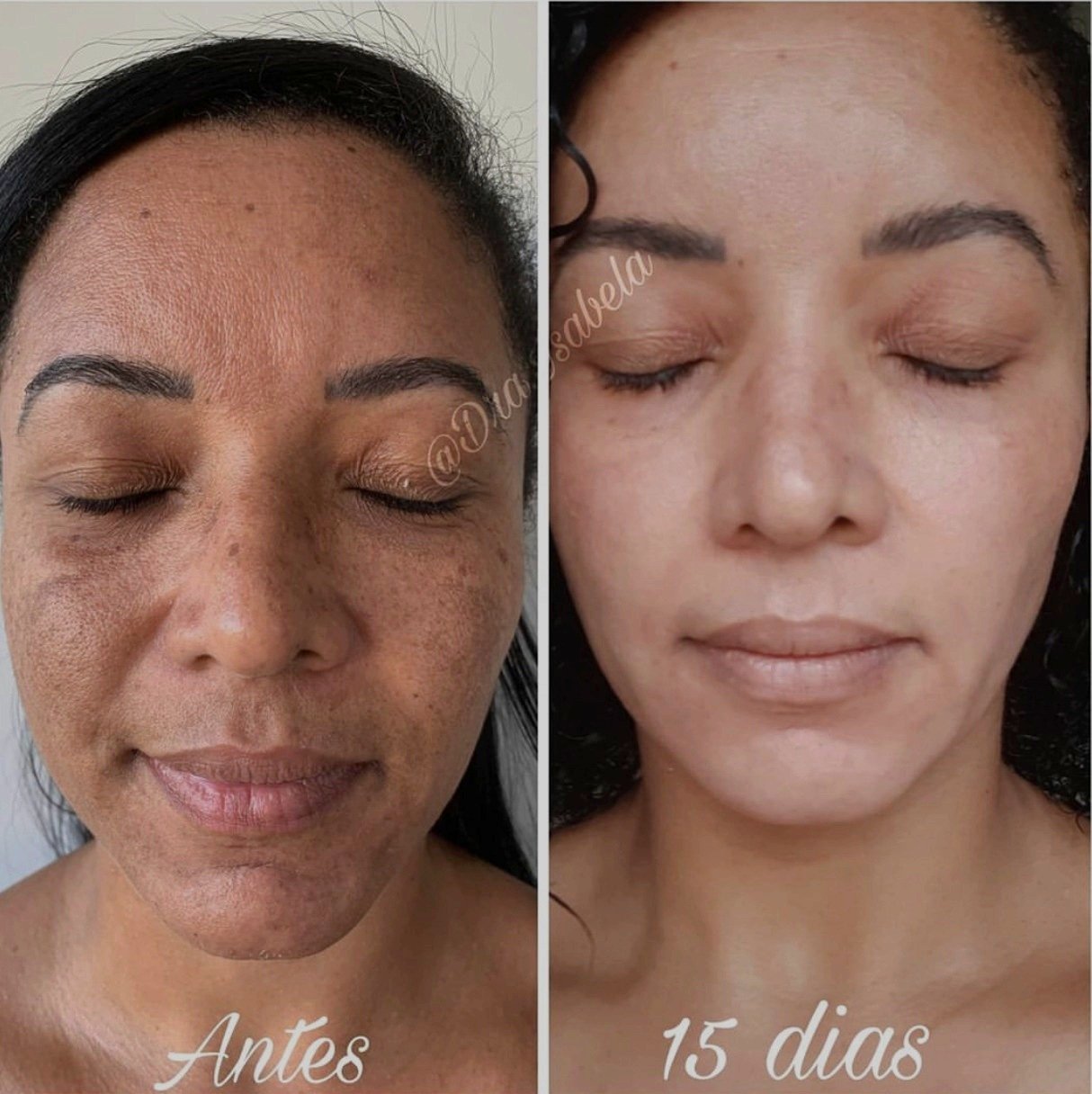 Peeling Mellanoff 3